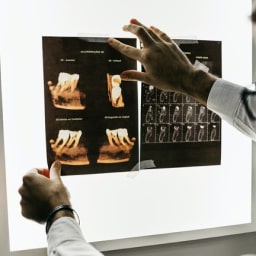 EXTRACIONES DENTALES